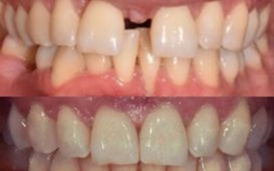 5 Reasons Why Australian Smile Clinics is the Best Choice for Clear Aligners