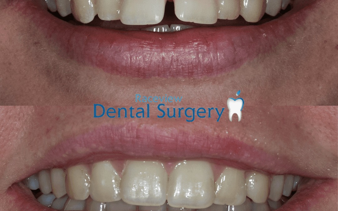 How To Know If You Are A Good Candidate for Clear Aligners Australian Smile Clinics