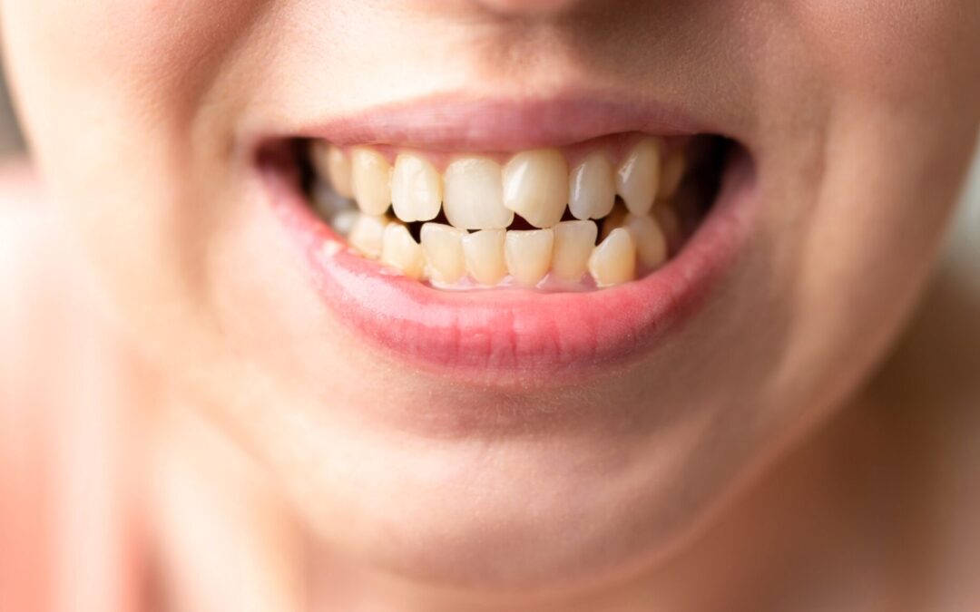 causes of crooked teeth