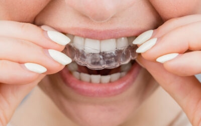 Unleash a Winning Smile: Can Clear Aligners Fix an Overbite?