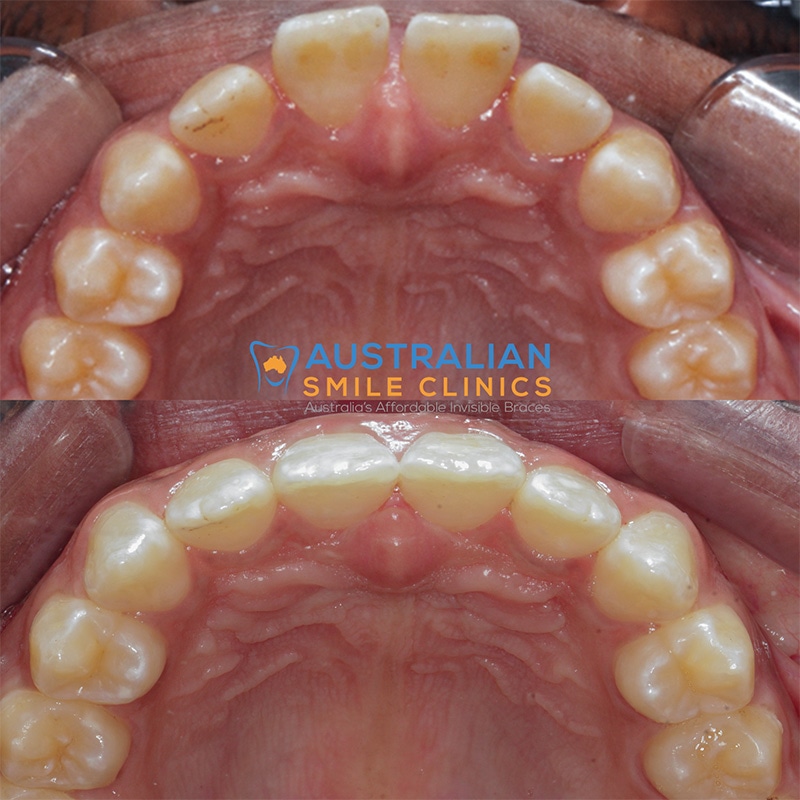 Clear Aligner Before and Afters | Clear Braces Smile Gallery