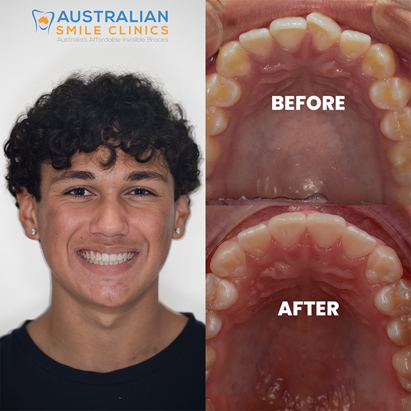 Clear Aligner Before and Afters