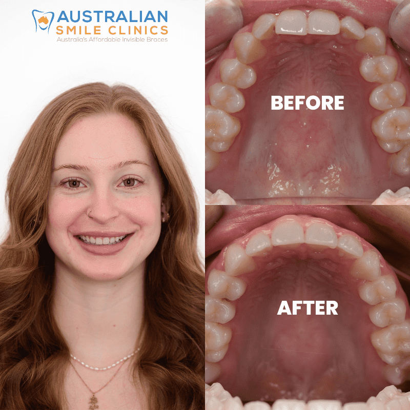 Clear Aligner Before and Afters